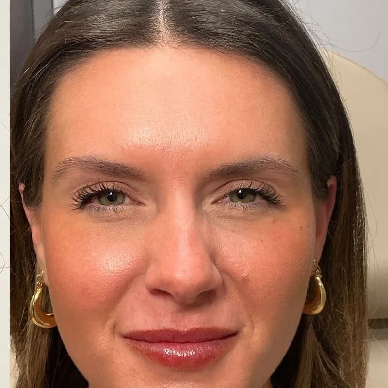Smoothed frown lines after Botox, same patient